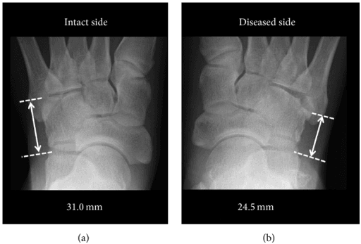 (a) Normal side with a lateral column of 31.0 mm. (b) Affected side with a lateral column of 24.5 mm.