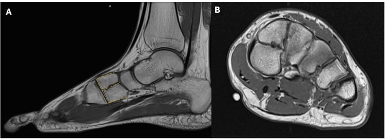 Sagittal MRI (A) with the E sign of a bipartite medial cuneiform outlined by a yellow dashed line, and short-axis MRI (B).