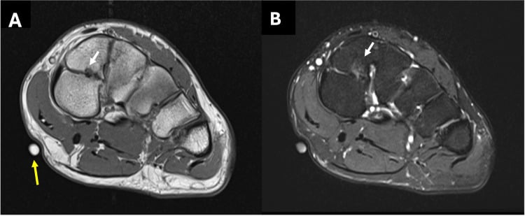 Short-axis T1 (A) and fluid-sensitive (B) MRI with white arrows at pseudoarthrosis and degenerative change of a bipartite medial-cuneiform synchondrosis; a yellow arrow marks a skin marker.