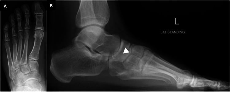 AP (A) and standing lateral (B) radiographs of a bipartite medial cuneiform, a white arrowhead on the lateral view.