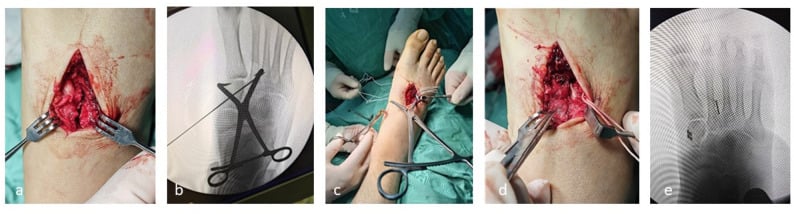 Five-panel operative and fluoroscopic sequence (a-e) of medial-cuneiform to second-metatarsal elastic Lisfranc fixation.