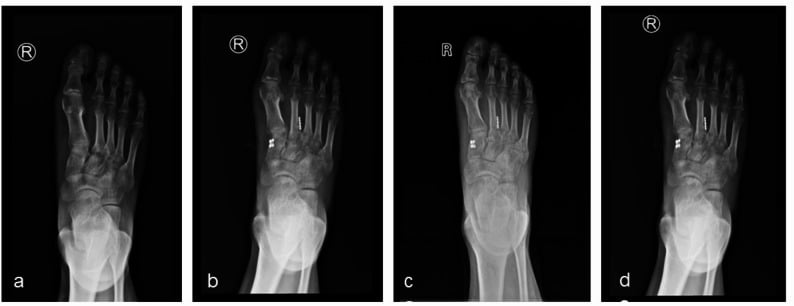 Four AP radiographs (a-d): before and serially after elastic Lisfranc fixation, showing restored alignment.
