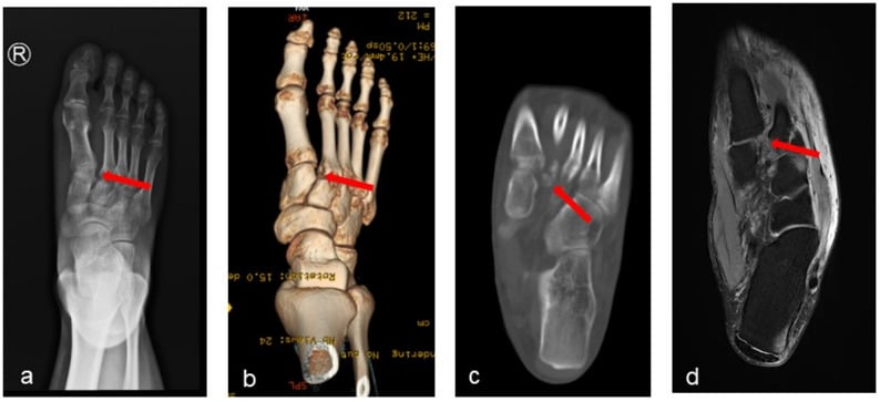 Weight-bearing AP radiograph (a), 3D CT (b), CT (c) and MRI (d), red arrows marking medial-cuneiform to second-metatarsal widening in a ligamentous Lisfranc injury.