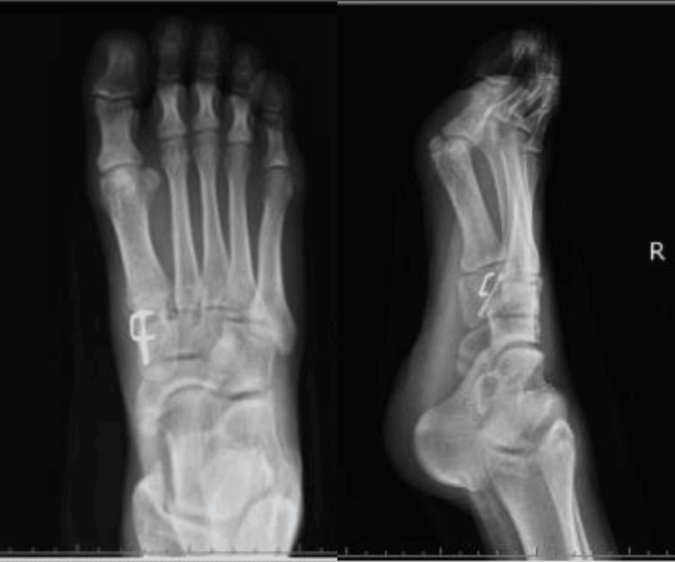 Two postoperative foot radiographs showing headless compression-screw and staple fixation of a medial-cuneiform nonunion.