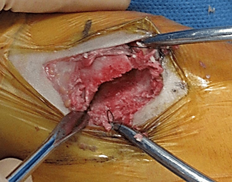 Operative close-up of a medial-cuneiform fracture nonunion after debridement.