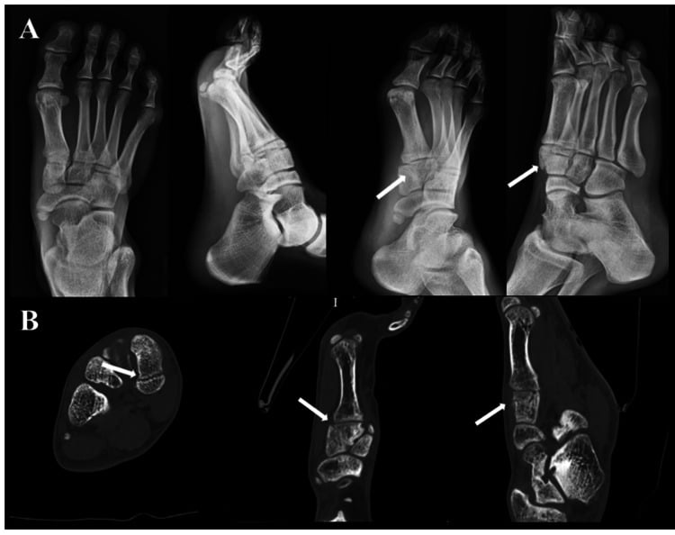 Radiographs (A) and CT (B) of a medial-cuneiform fracture nonunion, white arrows marking the fracture line.