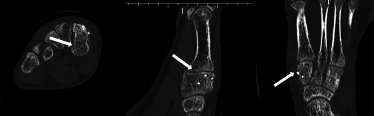 Three postoperative CT images, white arrows marking union of a surgically treated medial-cuneiform nonunion.