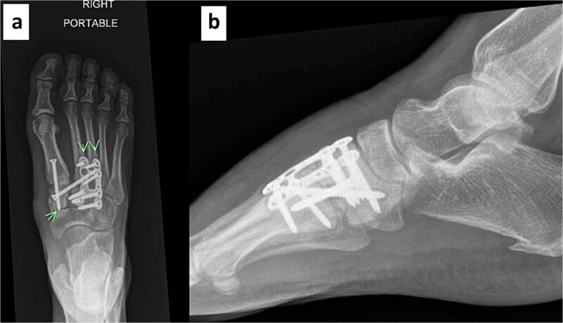 Six-month AP (a) and lateral (b) foot radiographs showing maintained reduction after fixation of an open medial-cuneiform fracture-dislocation.