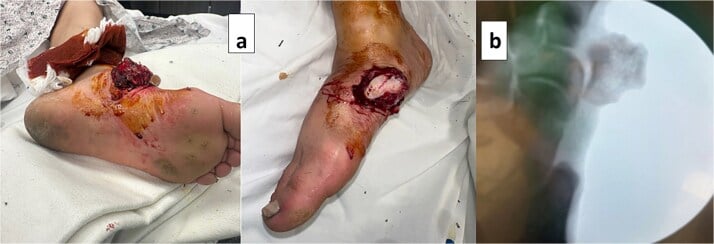 Clinical photographs of an open dorsomedial midfoot wound (a) and an initial radiograph (b) showing medial-cuneiform fracture-dislocation.