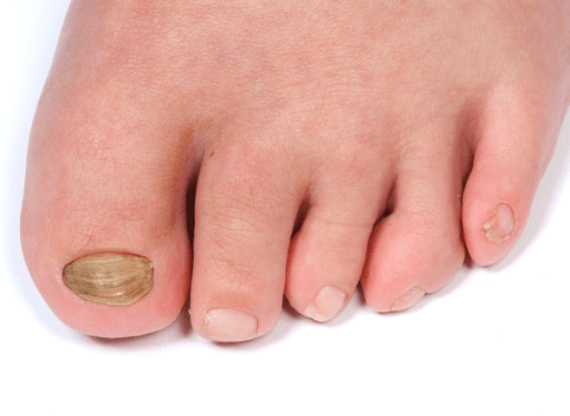 Close-up clinical photograph showing flexion and varus rotation of the lesser toes in a syndromic paediatric case