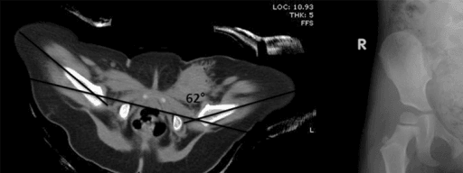 2-panel imaging showing DDH assessment with CT and X-ray