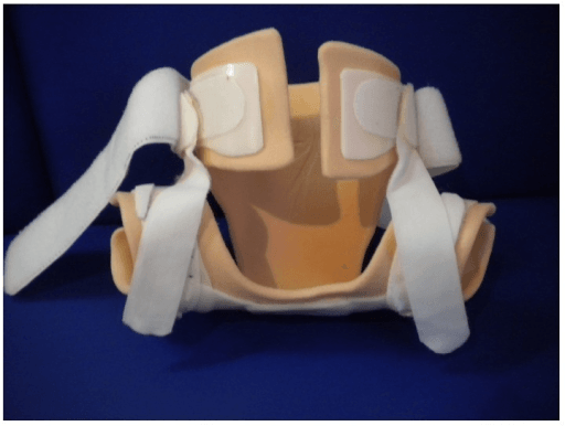 Hip abduction brace (Tübingen-type splint) for DDH treatment