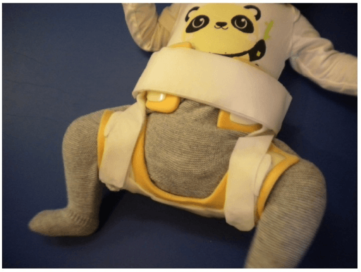 Abduction brace applied to infant demonstrating proper positioning