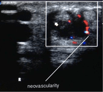 Colour Doppler ultrasound of the radial wrist showing neovascularity around the first-compartment tendons