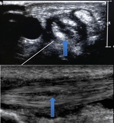 Ultrasound showing EPB tendon split in transverse and longitudinal views
