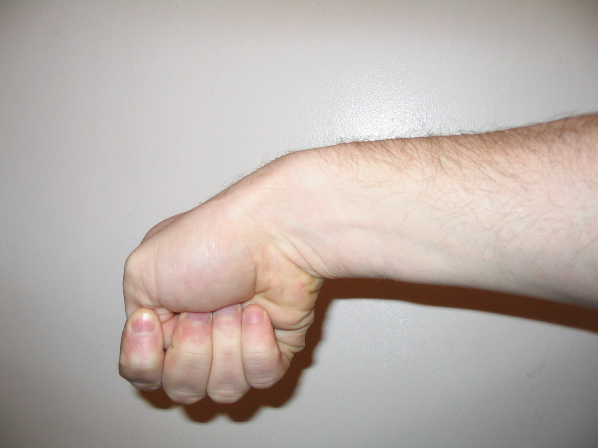 Clinical photograph of the Eichhoff manoeuvre: a fist closed over the thumb with the wrist deviated towards the little-finger side.