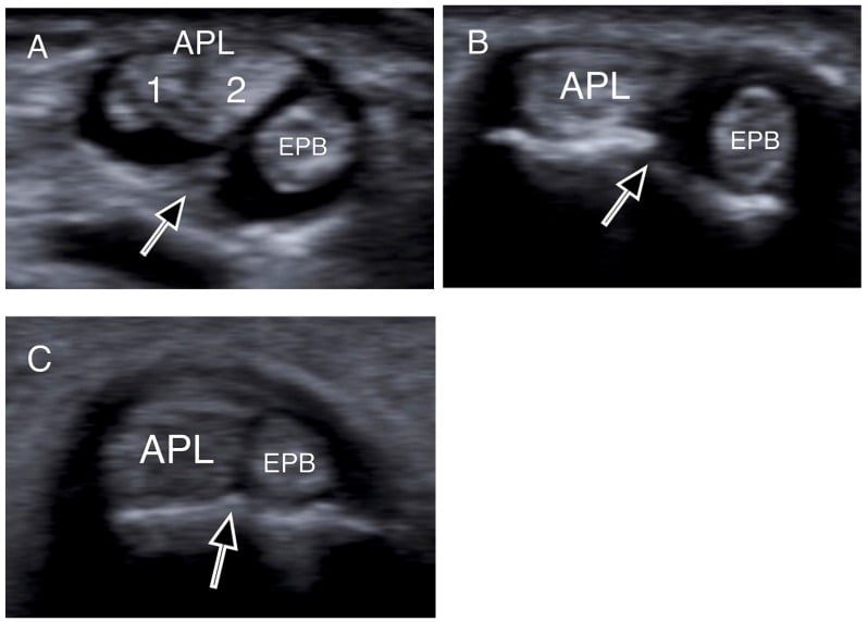 Three transverse ultrasound panels, labelled A, B and C, of the first dorsal compartment with APL and EPB labelled and arrows marking the ridge or septum between them; panel A shows two APL slips numbered 1 and 2.