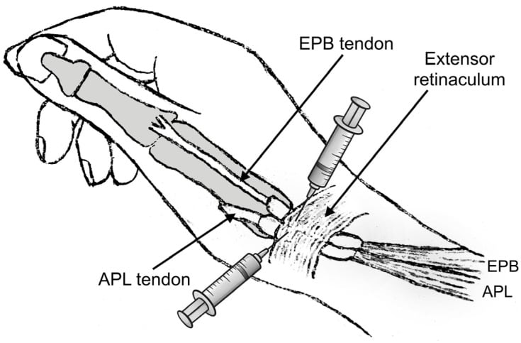 Line drawing of the radial wrist with two syringes, one directed along the labelled EPB tendon and one along the labelled APL tendon where they pass beneath the labelled extensor retinaculum.
