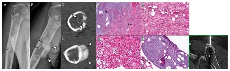 Multimodal radiograph, CT, MRI, histology and bone-scan imaging of proximal-humeral dedifferentiated chondrosarcoma with skeletal metastases.