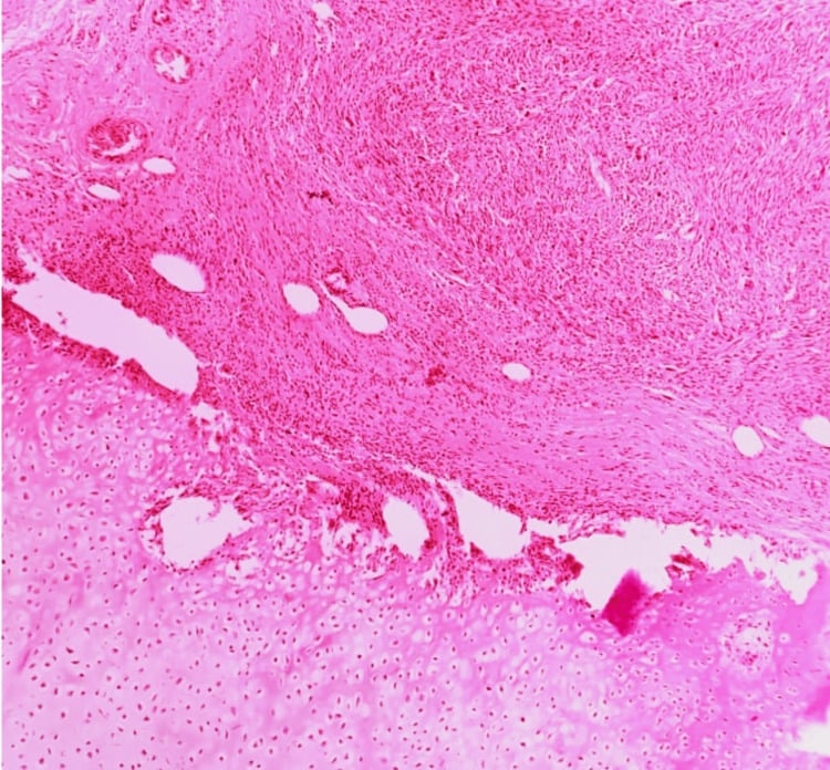 Low-power H and E histology showing an abrupt junction between pale cartilaginous tumour and a highly cellular spindle-cell sarcoma.