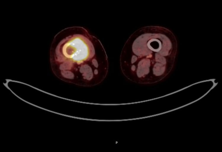 Axial FDG PET-CT of a distal-femoral dedifferentiated chondrosarcoma showing a heterogeneous hypermetabolic mass with calcific foci.