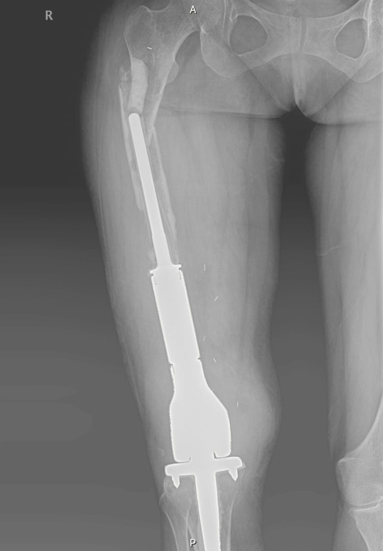 Long-leg postoperative radiograph showing modular distal-femoral endoprosthetic replacement with a hinged total knee after tumour resection.