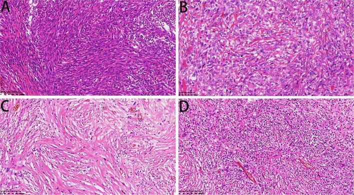 Four H and E panels showing varied spindle-cell, fibrosarcoma-like, sclerosing and storiform patterns in dedifferentiated chondrosarcoma.