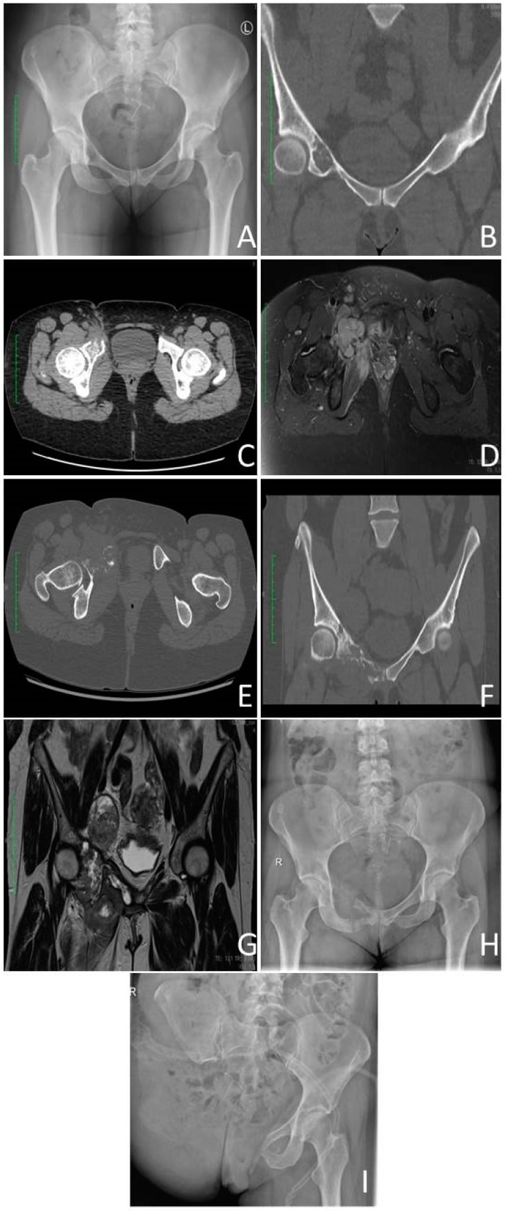 Serial radiograph, CT and MRI of a right pubic dedifferentiated chondrosarcoma showing progression from a chondral lesion to an aggressive mass.