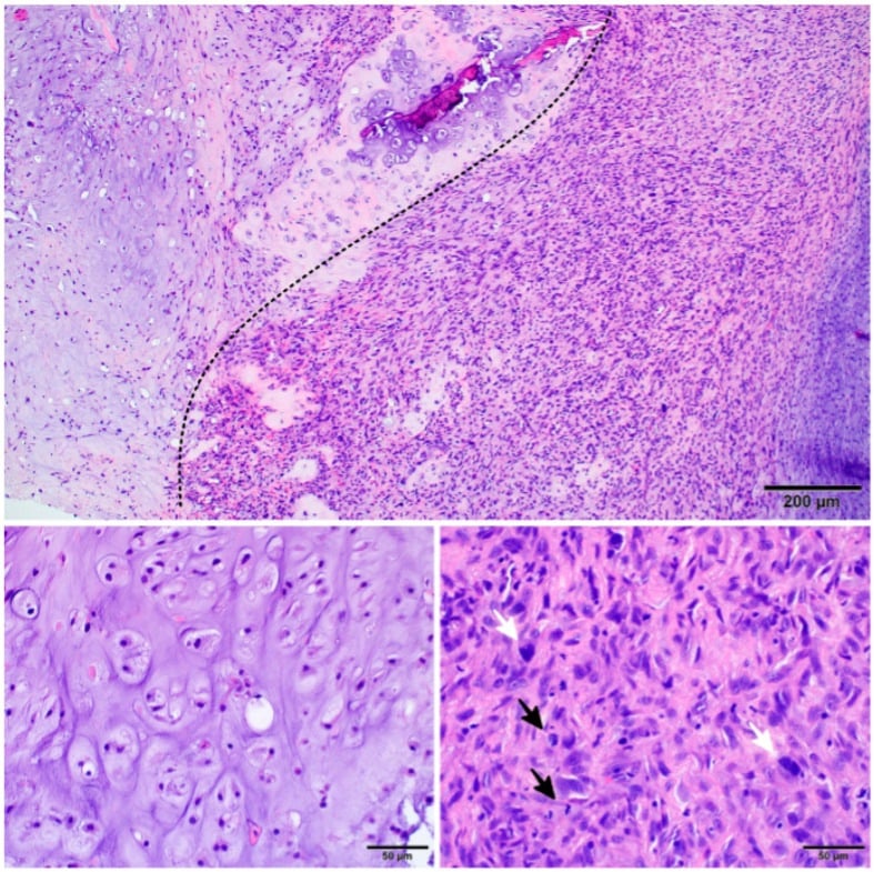 H and E histology with a dotted line marking the clear-cut transition between low-grade cartilage tumour and high-grade pleomorphic sarcoma.