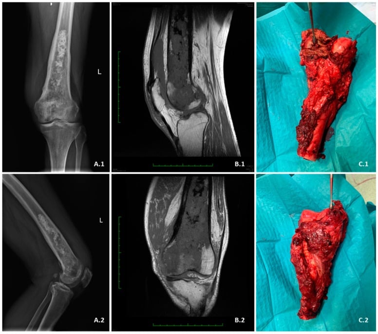Preoperative radiographs and MRI with intraoperative resection specimens from a distal-femoral dedifferentiated chondrosarcoma.