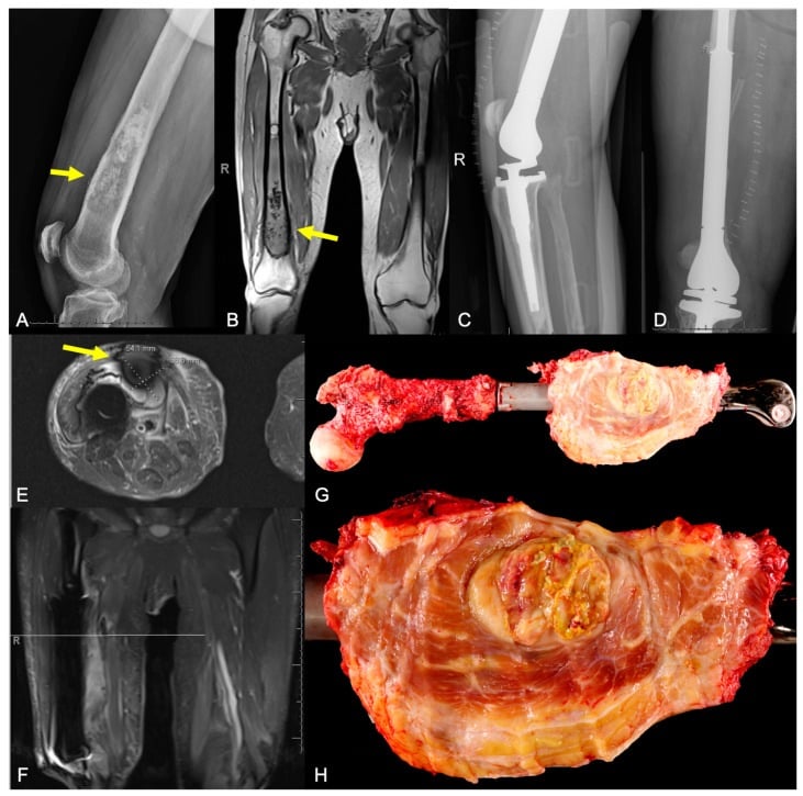 Radiograph, MRI, postoperative endoprosthesis films and gross specimen showing local recurrence after wide femoral resection and reconstruction.