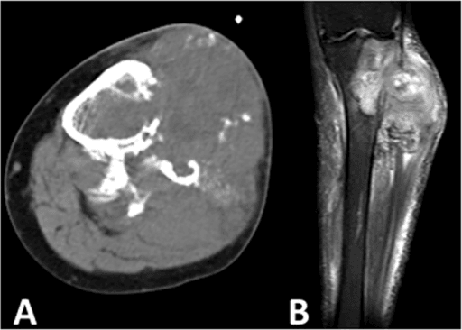 Axial CT of the proximal tibia and fibula with flocculent calcified cartilage matrix and an adjacent soft-tissue mass.