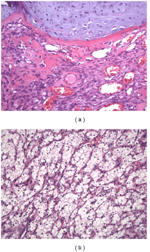 Two high-power H and E stained histology panels, one of femoral dedifferentiated chondrosarcoma and one of clear-cell renal cell carcinoma.