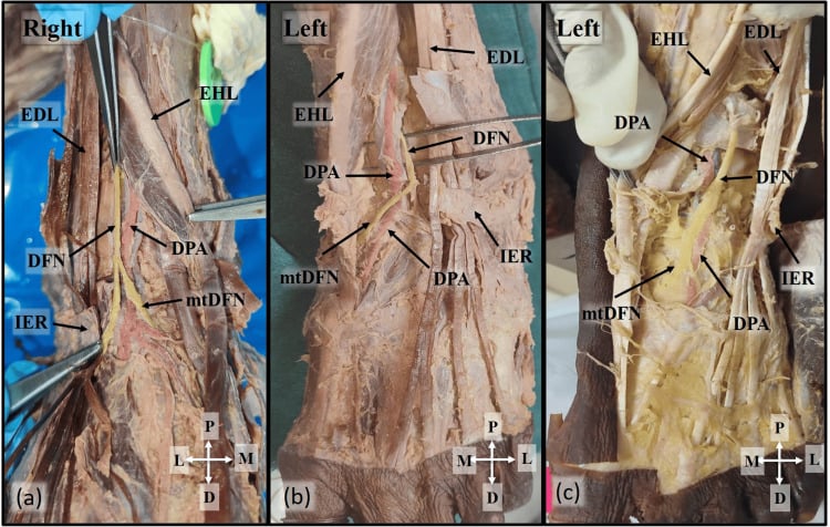 Anatomical dissection of deep peroneal nerve within the anterior tarsal tunnel