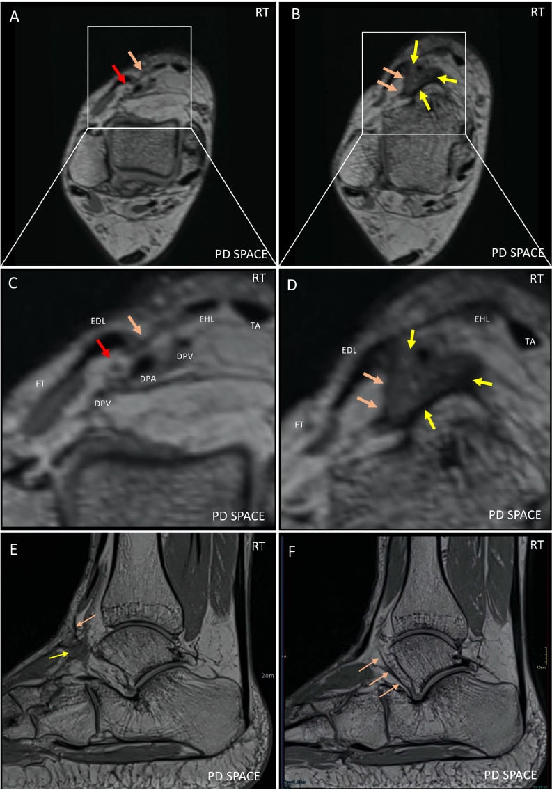 Axial PD MRI of ankle demonstrating deep peroneal nerve compression in anterior tarsal tunnel syndrome