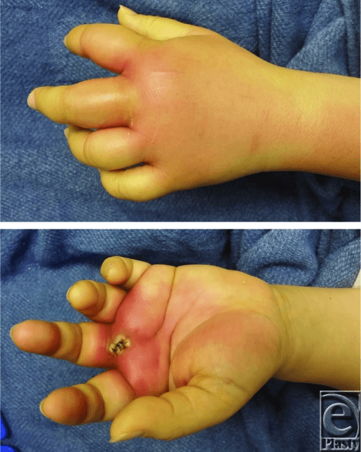 Clinical photographs showing collar button abscess of the hand