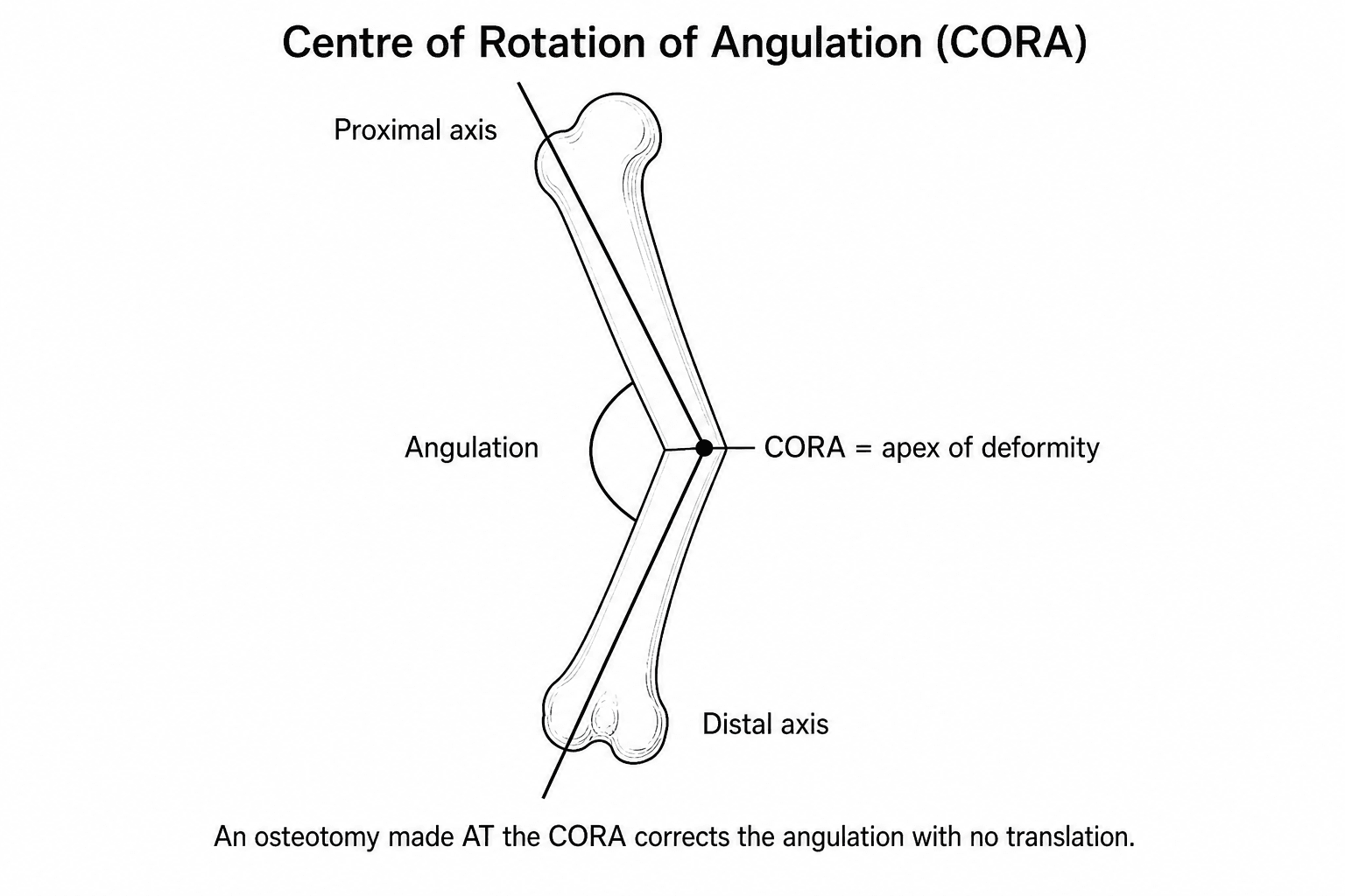 Diagram of an angulated long bone with the proximal and distal axis lines extended to intersect at the centre of rotation of angulation (CORA), the apex of the deformity.