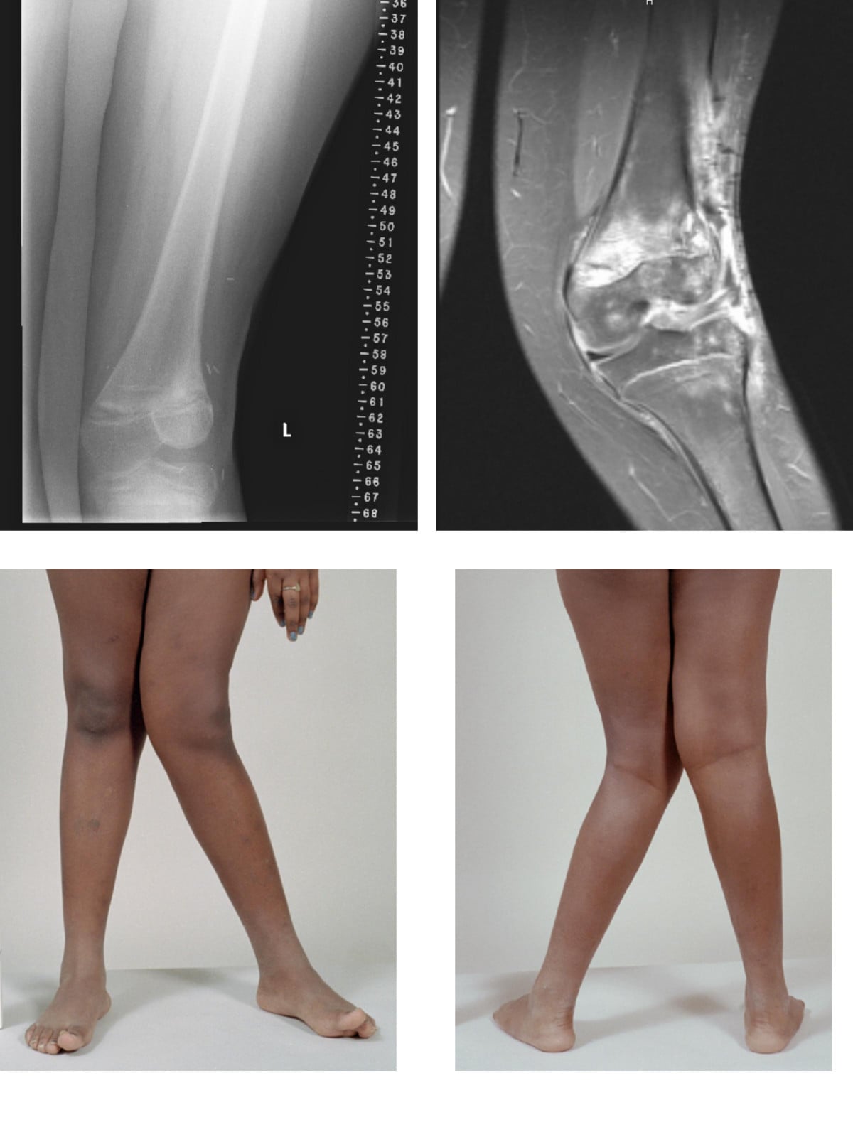 AP knee radiograph and sagittal MRI with standing clinical photographs of genu valgum