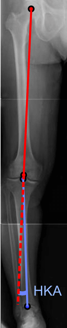 Full-length AP radiograph of the right leg with the mechanical axis and hip-knee-ankle (HKA) angle annotated