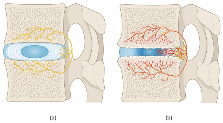 Side-by-side diagrams of normal disc innervation and pathological neovascular and neural ingrowth in degeneration
