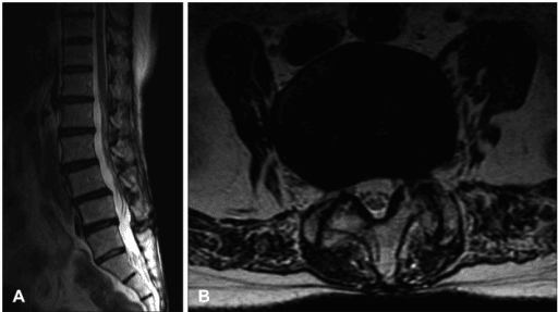 Sagittal and axial T2 MRI of degenerative spondylolisthesis with canal stenosis