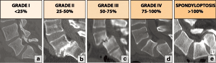 Meyerding classification of spondylolisthesis measured on the lateral radiograph - grades I-IV and spondyloptosis