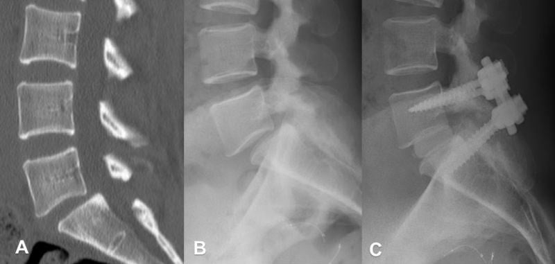 CT, lateral radiograph and post-operative radiograph of L5-S1 degenerative spondylolisthesis