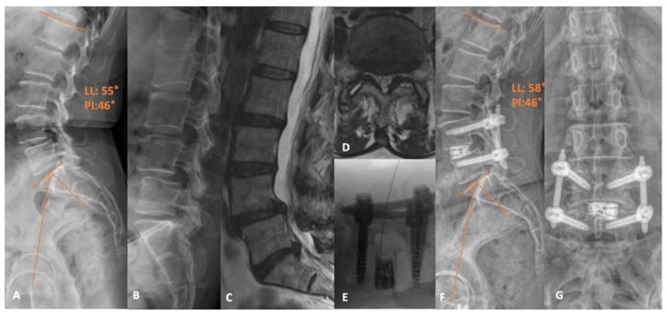 Standing and flexion radiographs with sagittal and axial MRI before L4-5 TLIF