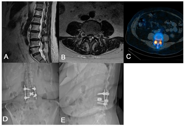 Lumbar MRI and SPECT CT showing active facet pathology before short-segment TLIF