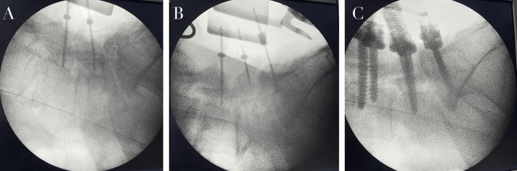 Sequential fluoroscopic images of pedicle cannulation, screw insertion and rod fixation