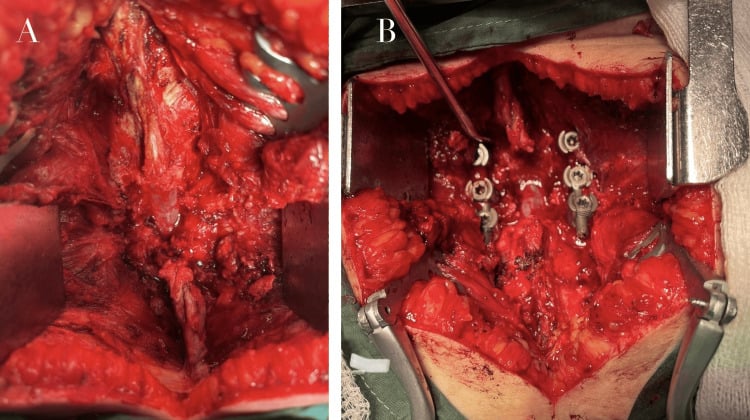 Posterior lumbar exposure before and after bilateral pedicle screw and rod placement