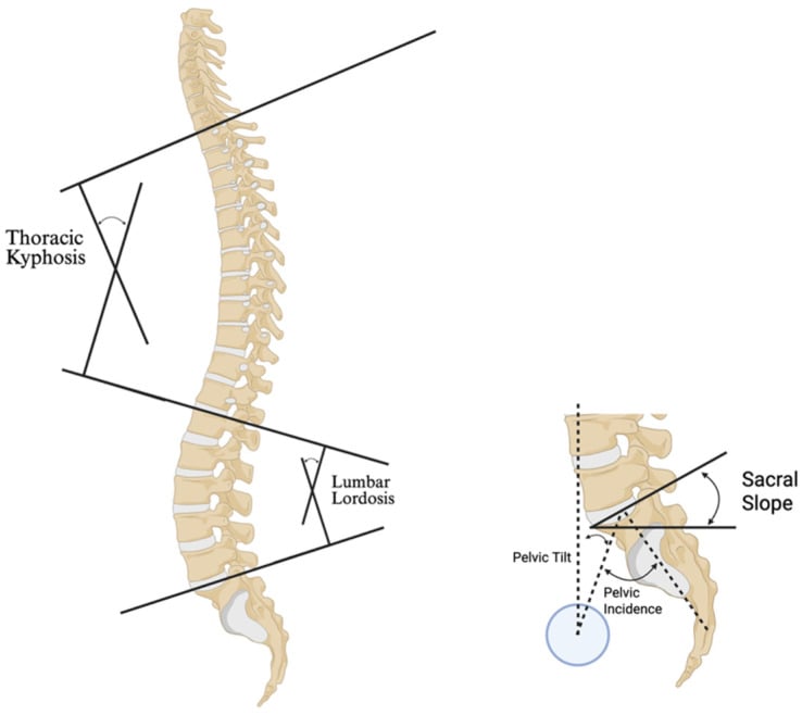 Diagram showing lumbar lordosis, pelvic incidence, pelvic tilt and sacral slope measurements
