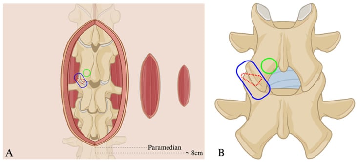 Posterior lumbar diagram comparing open midline and paramedian TLIF access corridors