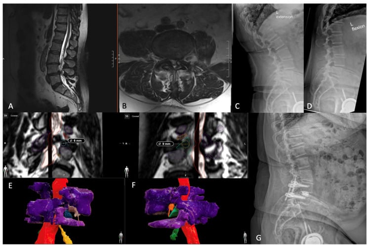 MRI, flexion-extension radiographs, 3D planning and postoperative TLIF radiograph
